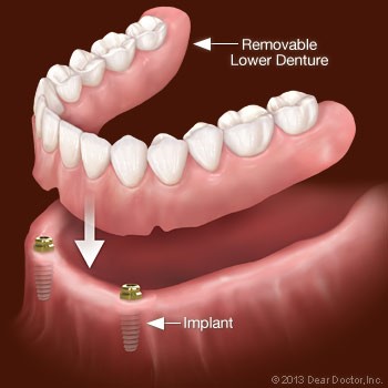 Braces With Partial Dentures Erbacon WV 26203